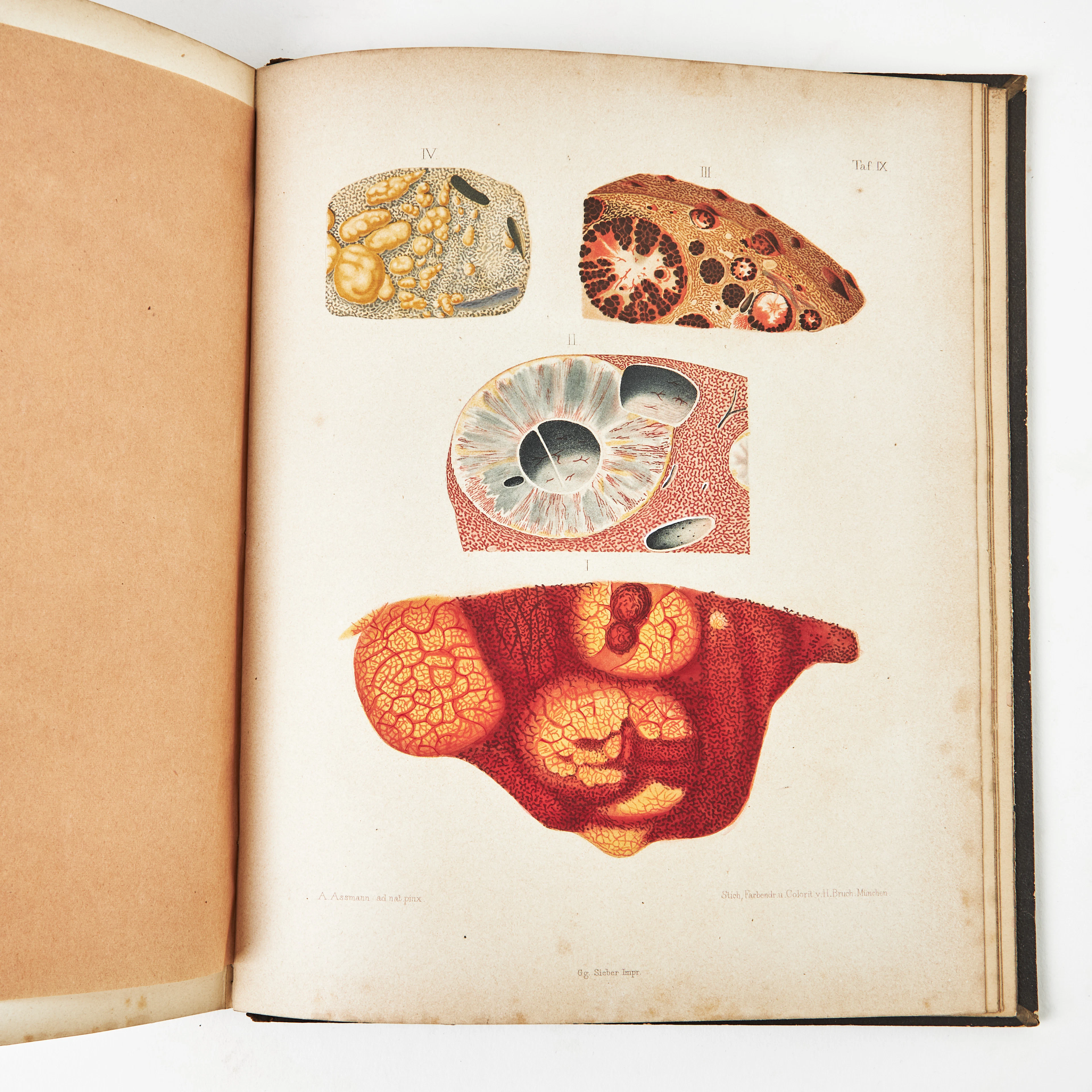 MEDICIN. ATLAS LEBERKRANKHEITEN, 1861, med planscher.