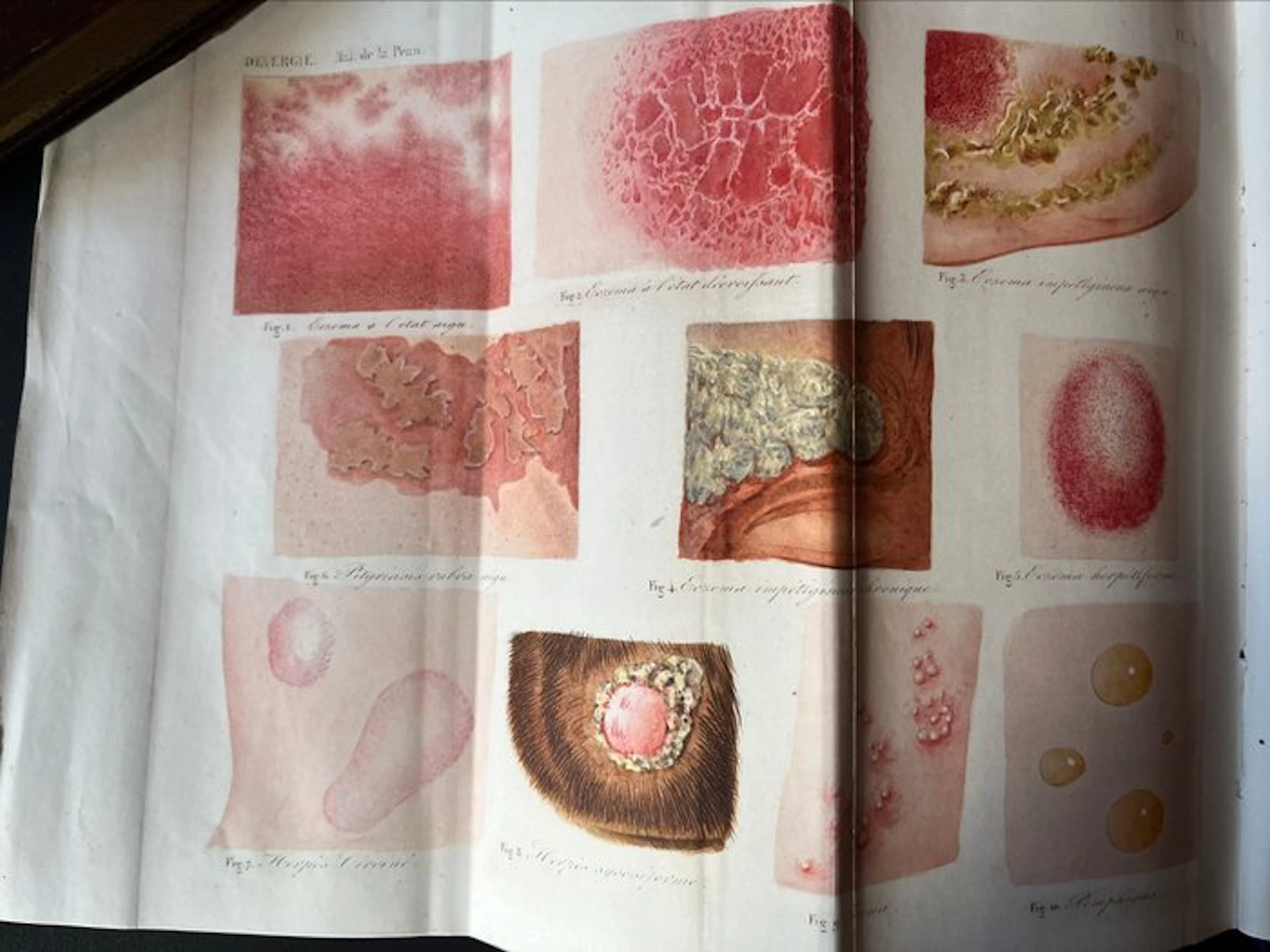 Alph. Devergie - Traité pratique des maladies de la peau & Atlas illustré