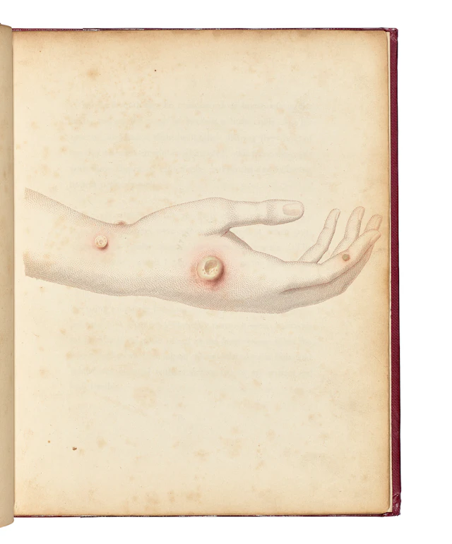 JENNER, Edward (1749-1823)