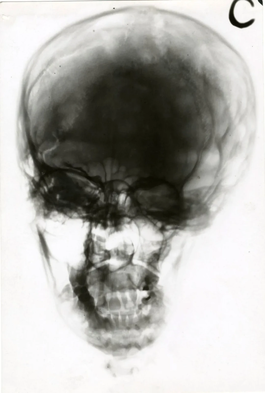 X-ray of a Skull - Lot 22