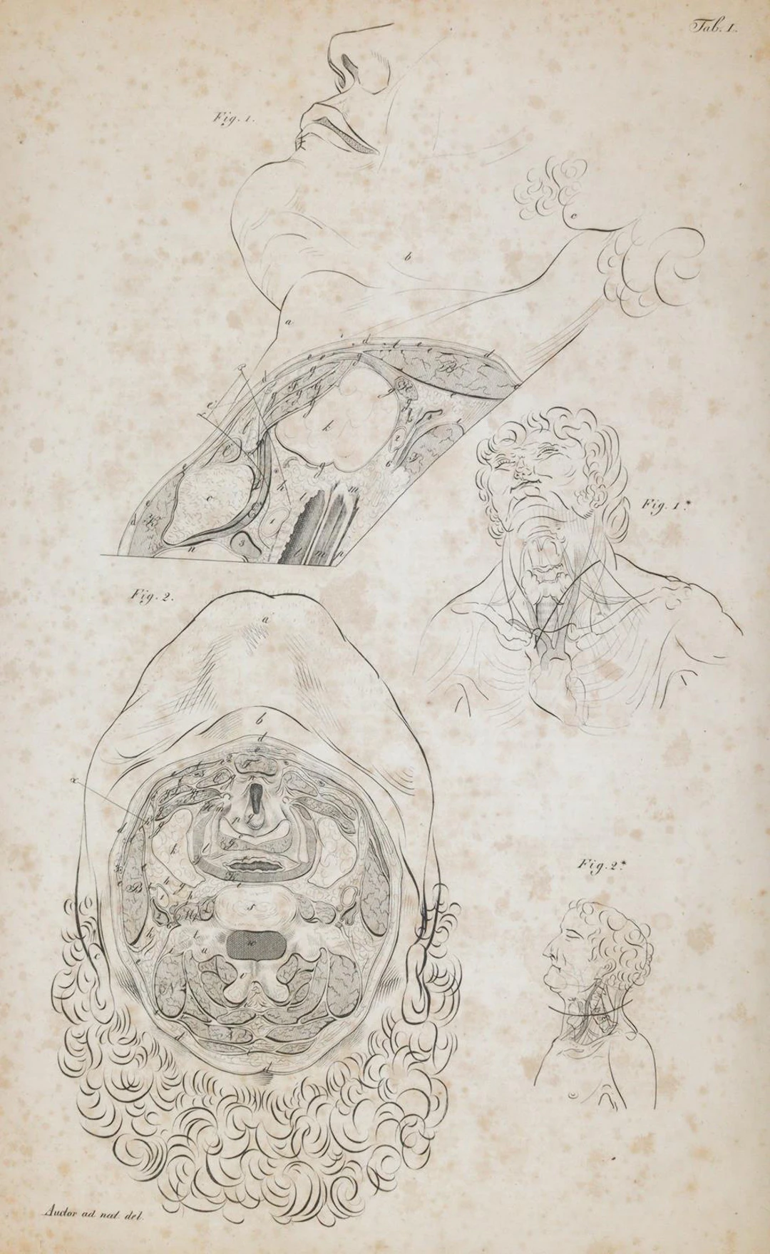 Froriep,R. Chirurgische Anatomie der Ligaturstellen am meschlichen Körper