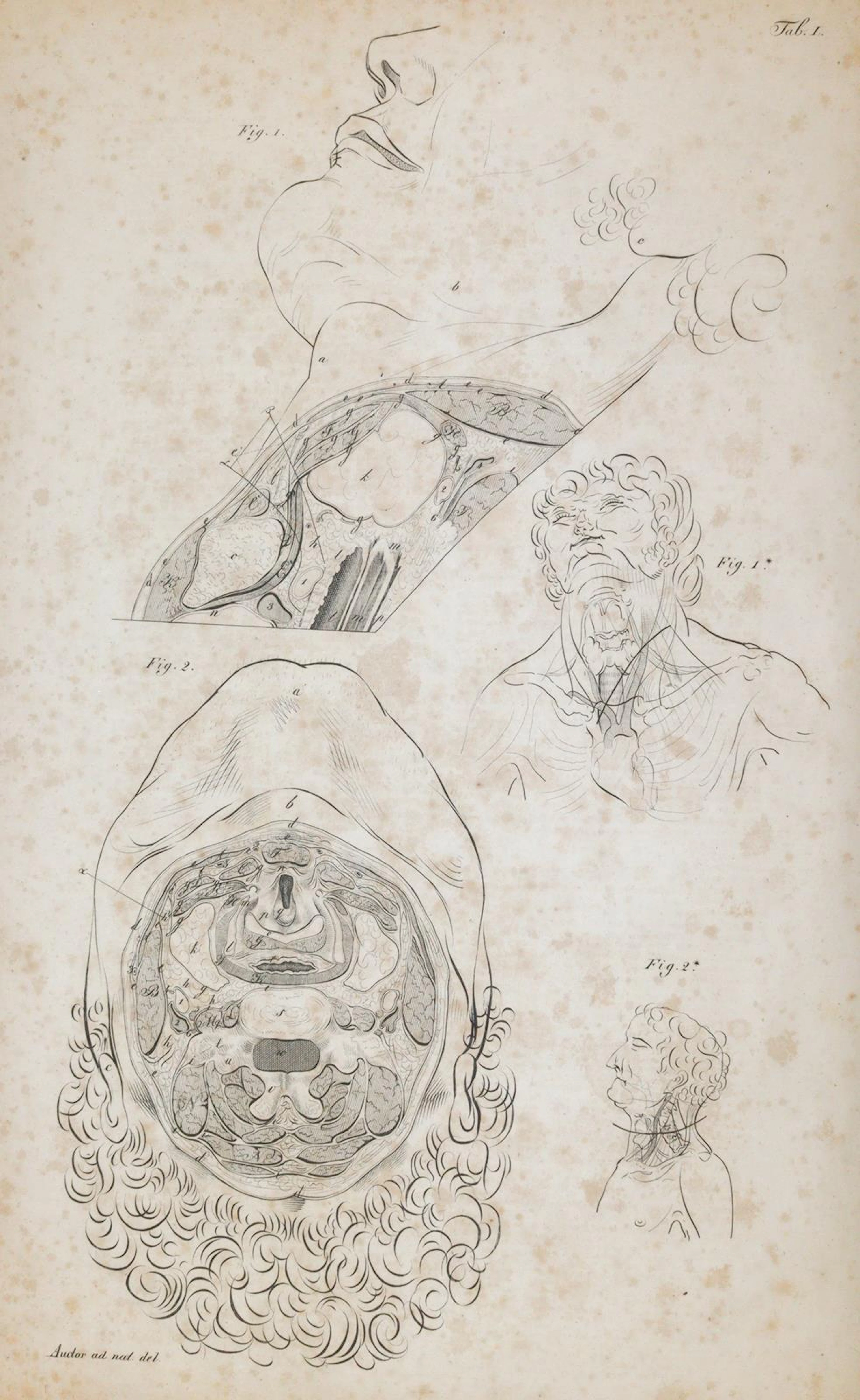 Froriep,R. Chirurgische Anatomie der Ligaturstellen am meschlichen Körper